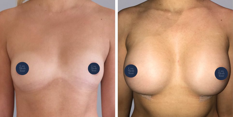 Breast Augmentation boob job before and after photo