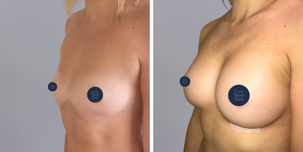 Breast Augmentation boob job before and after photo