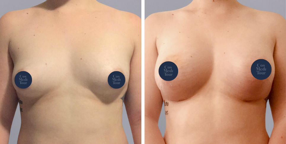 Why do I require a Breast Lift? - CosMediTour