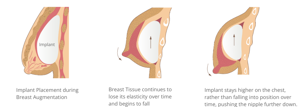 Various types of breast deformities. a Grade I breast contracture. a