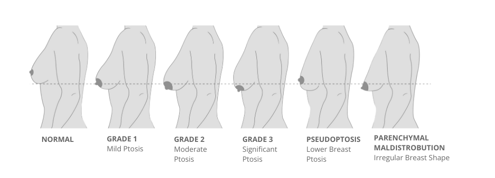 Various types of breast deformities. a Grade I breast contracture. a