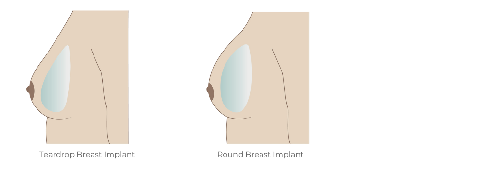 Image showing differences between round and teardrop shaped breast