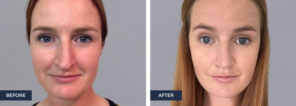 A Guide To Rhinoplasty In Australia 